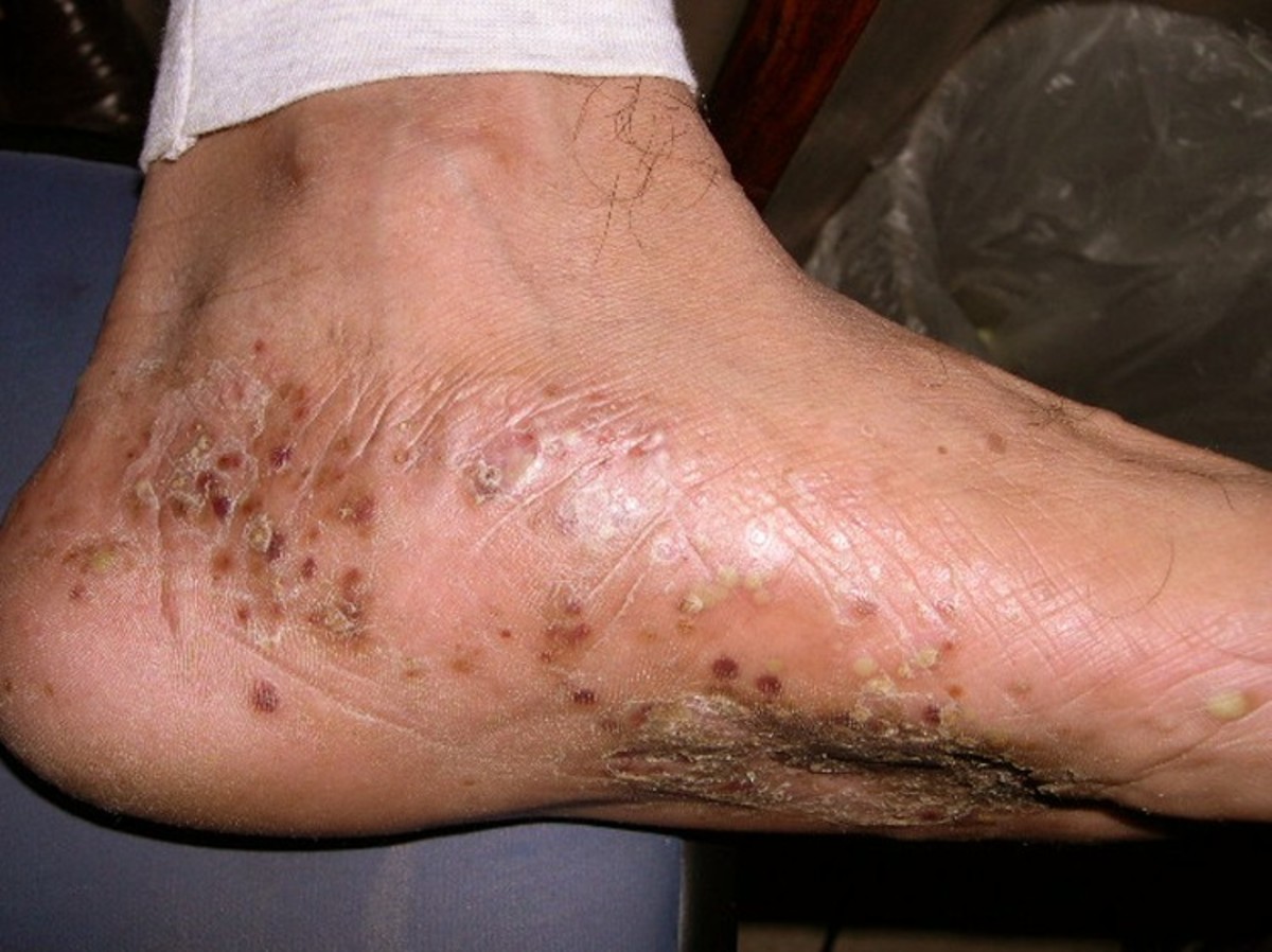 socks for eczema on feet 1