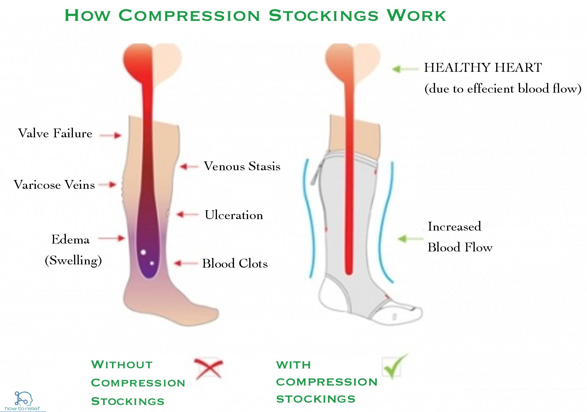 compression socks for hypertension 1