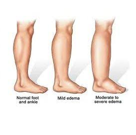 compression socks for edema 2