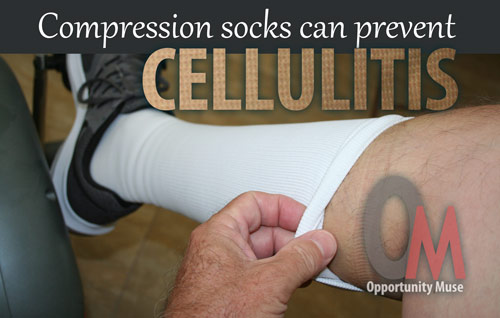 socks for cellulitis 1