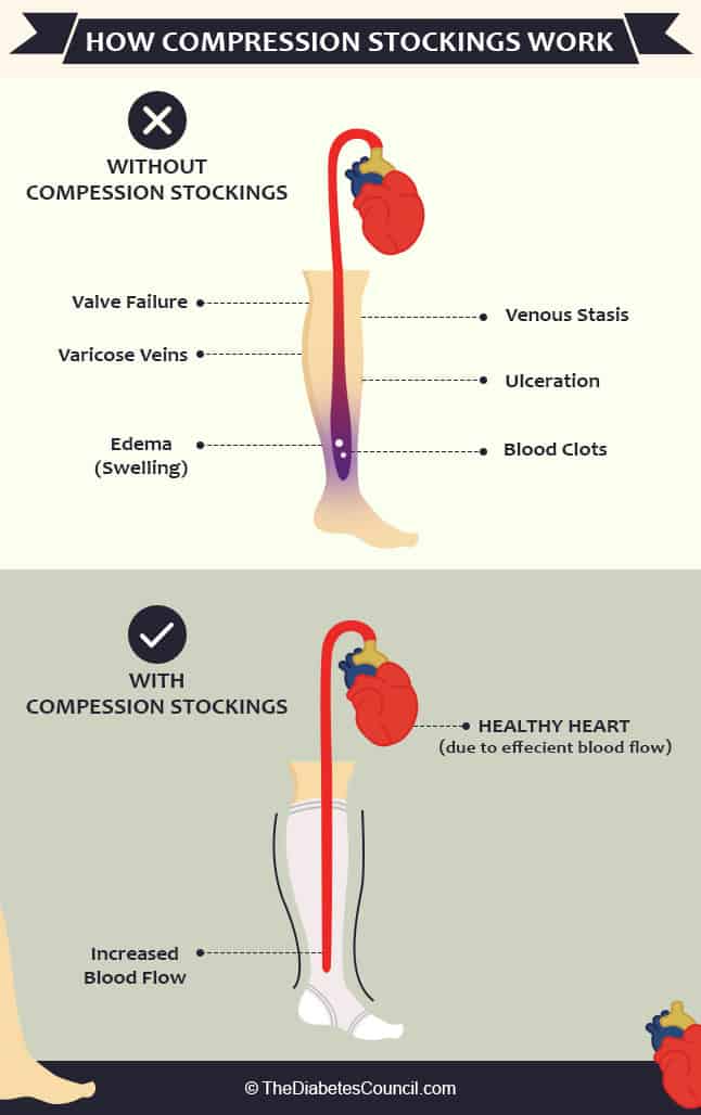 compression socks for low blood pressure 1