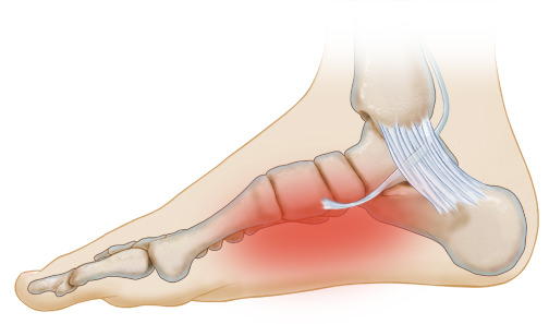 compression socks for posterior tibial tendonitis 2