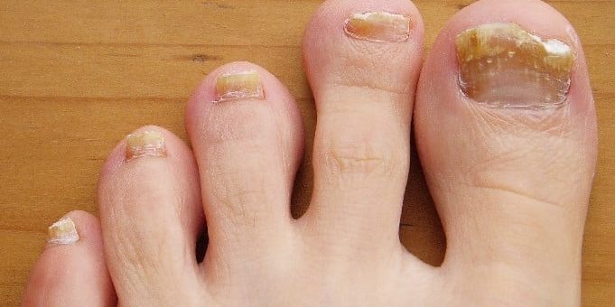 socks to prevent toenail fungus 2